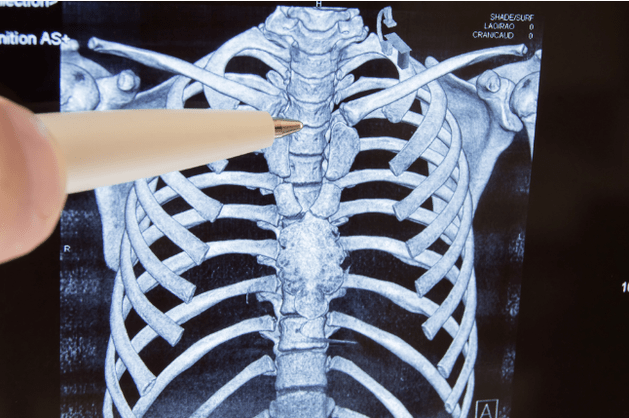 Osteocondrosi