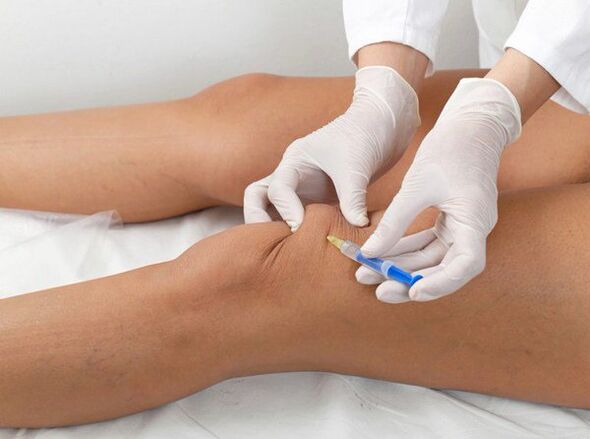 Iniezione intrarticolare per l'artrosi del ginocchio