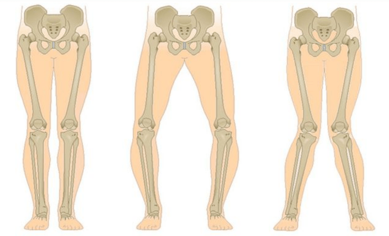 Complicazioni dell'artrosi del ginocchio